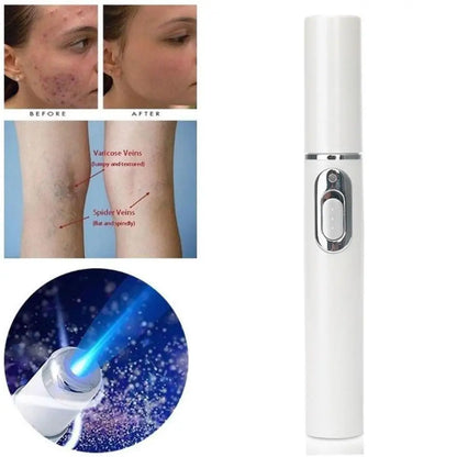 Bolígrafo LED Antiacné de Luz Azul – Terapia Facial para Acné, Cicatrices y Arrugas