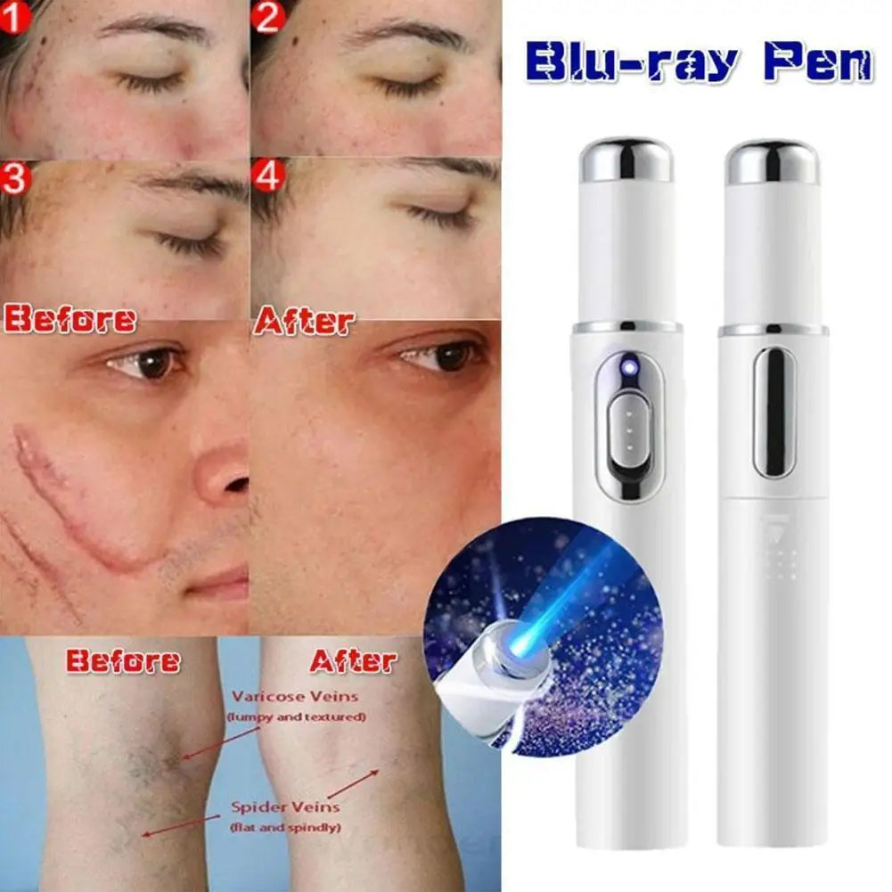Bolígrafo LED Antiacné de Luz Azul – Terapia Facial para Acné, Cicatrices y Arrugas