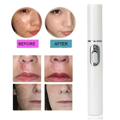 Bolígrafo LED Antiacné de Luz Azul – Terapia Facial para Acné, Cicatrices y Arrugas
